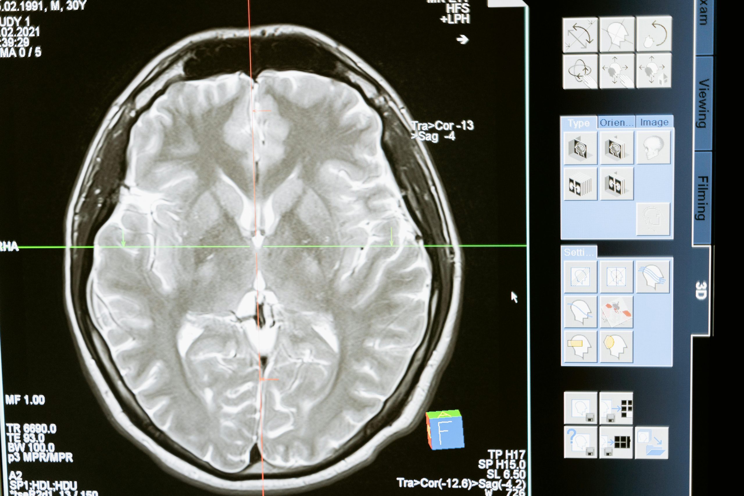 Alzheimer's diagnosis