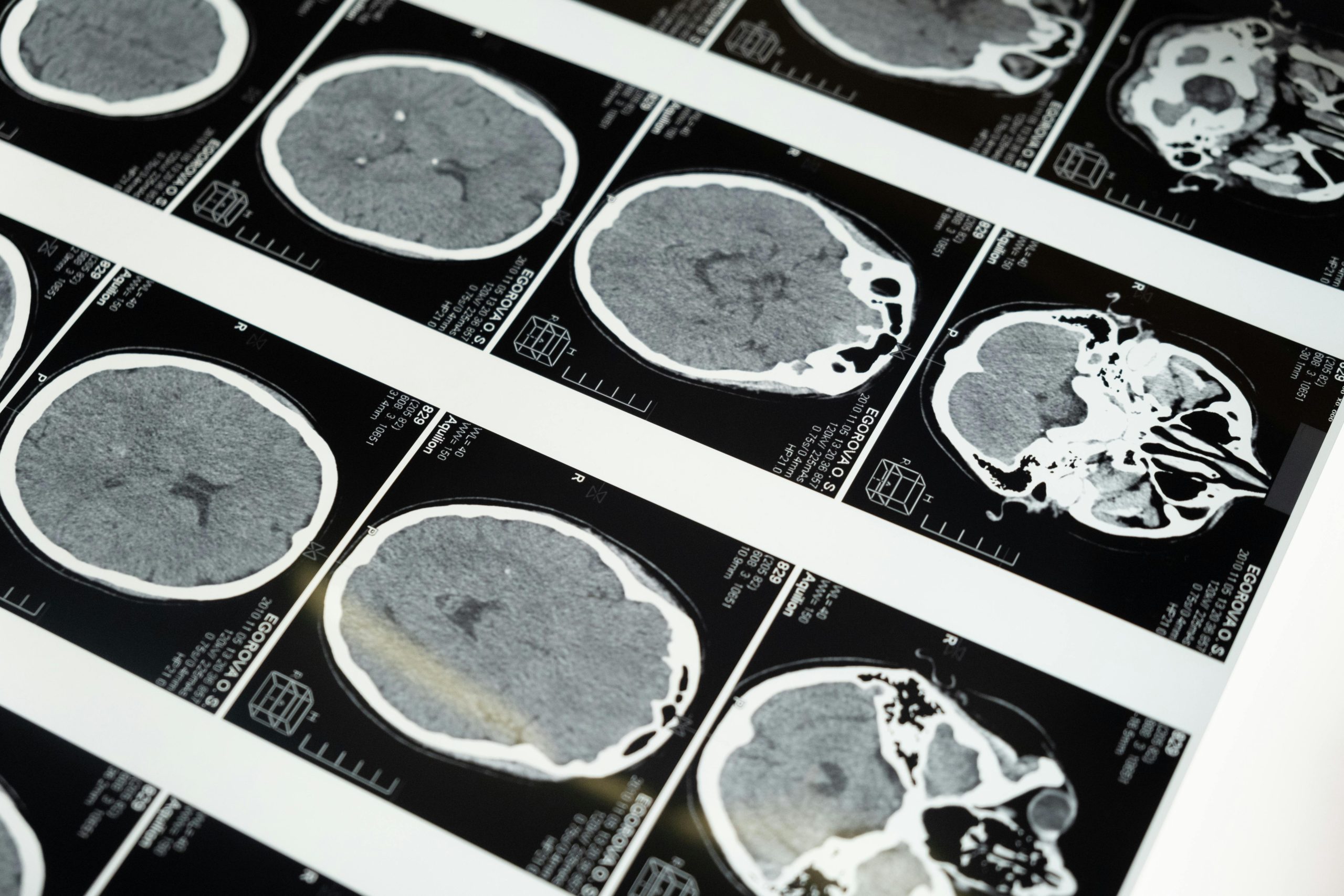 innovative alzheimer’s treatment in focus